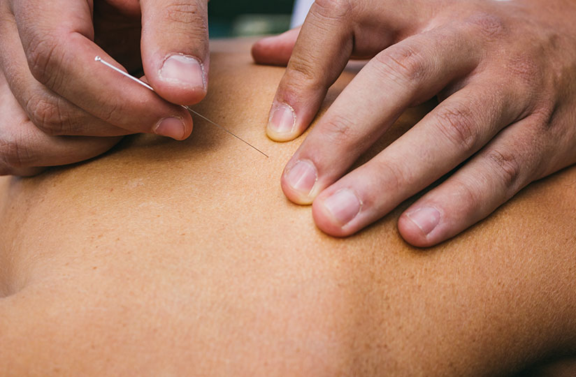 Acupunture Acupunture